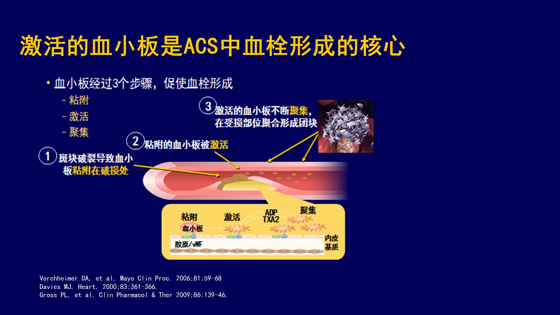 【连载】2血小板与抗血小板治疗-血栓相关疾病的规范化诊疗及研究进展