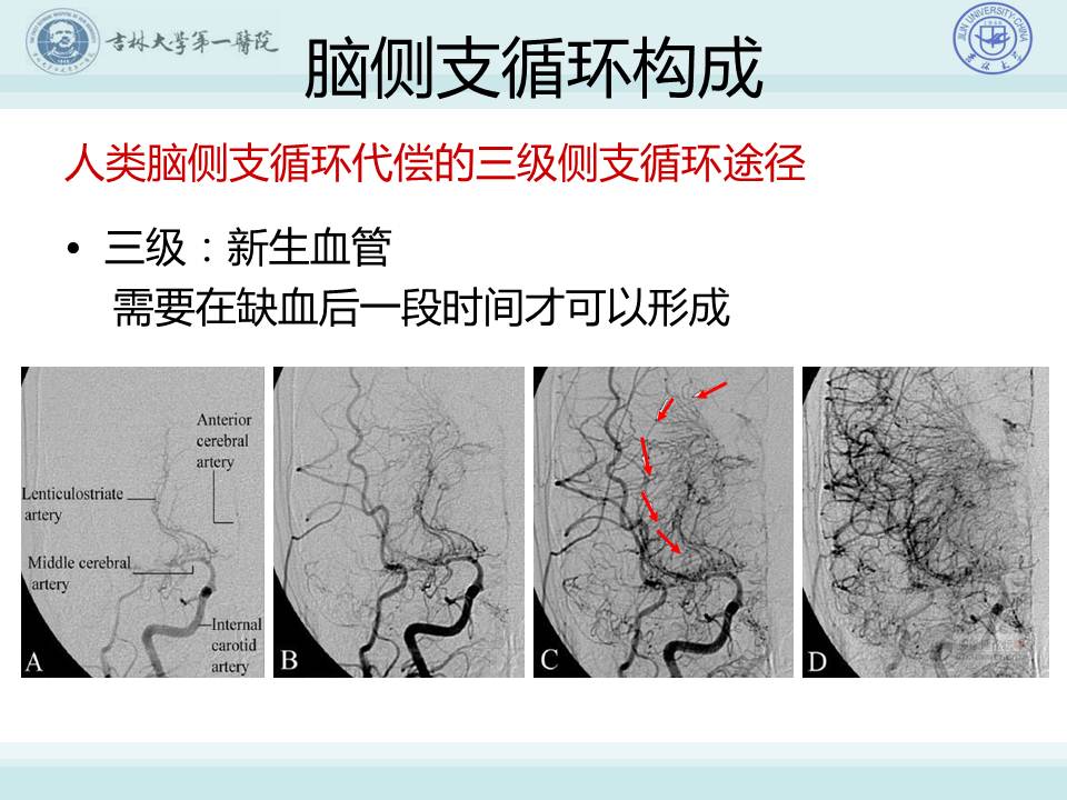 【连载】3脑侧支循环建立的重要性与评估技术-常见脑血管病的规范化