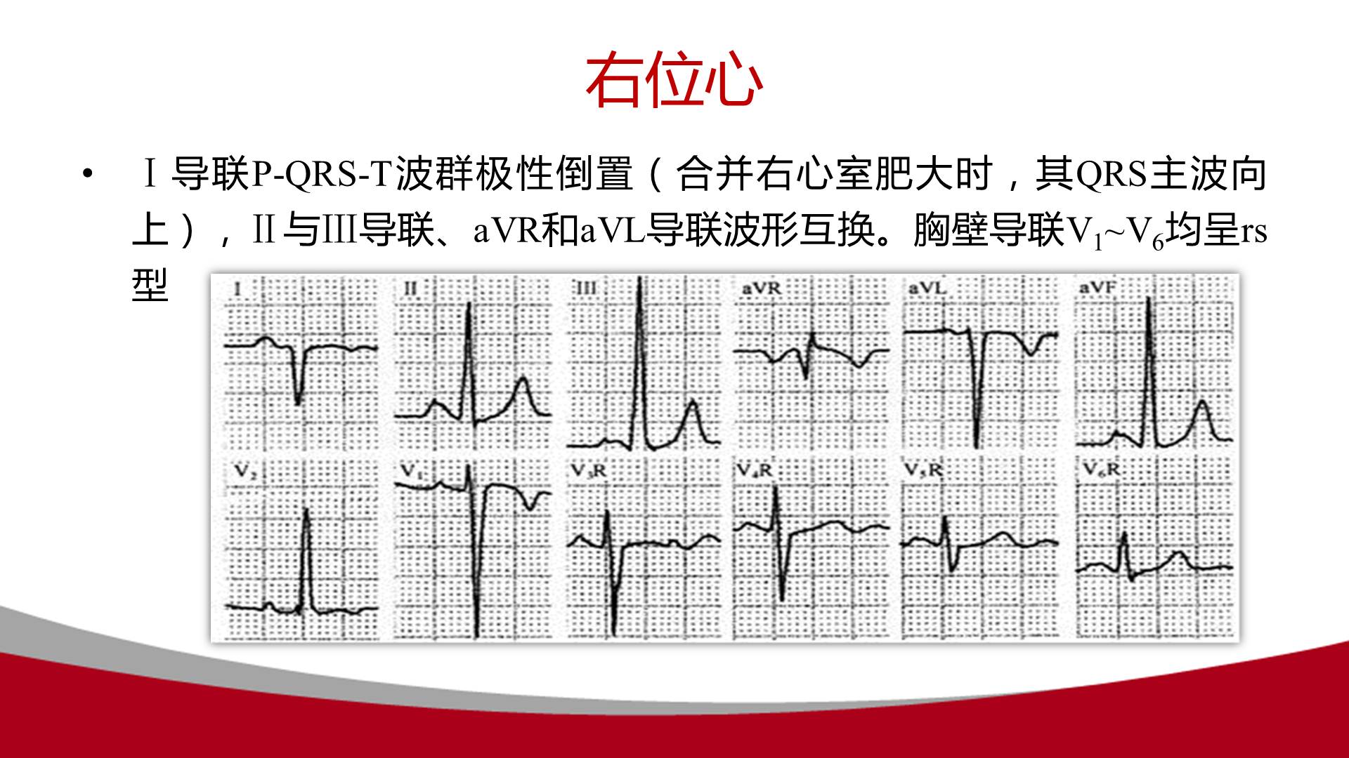 【连载】心电图的实用解析-1avr导联在动态心电图中的