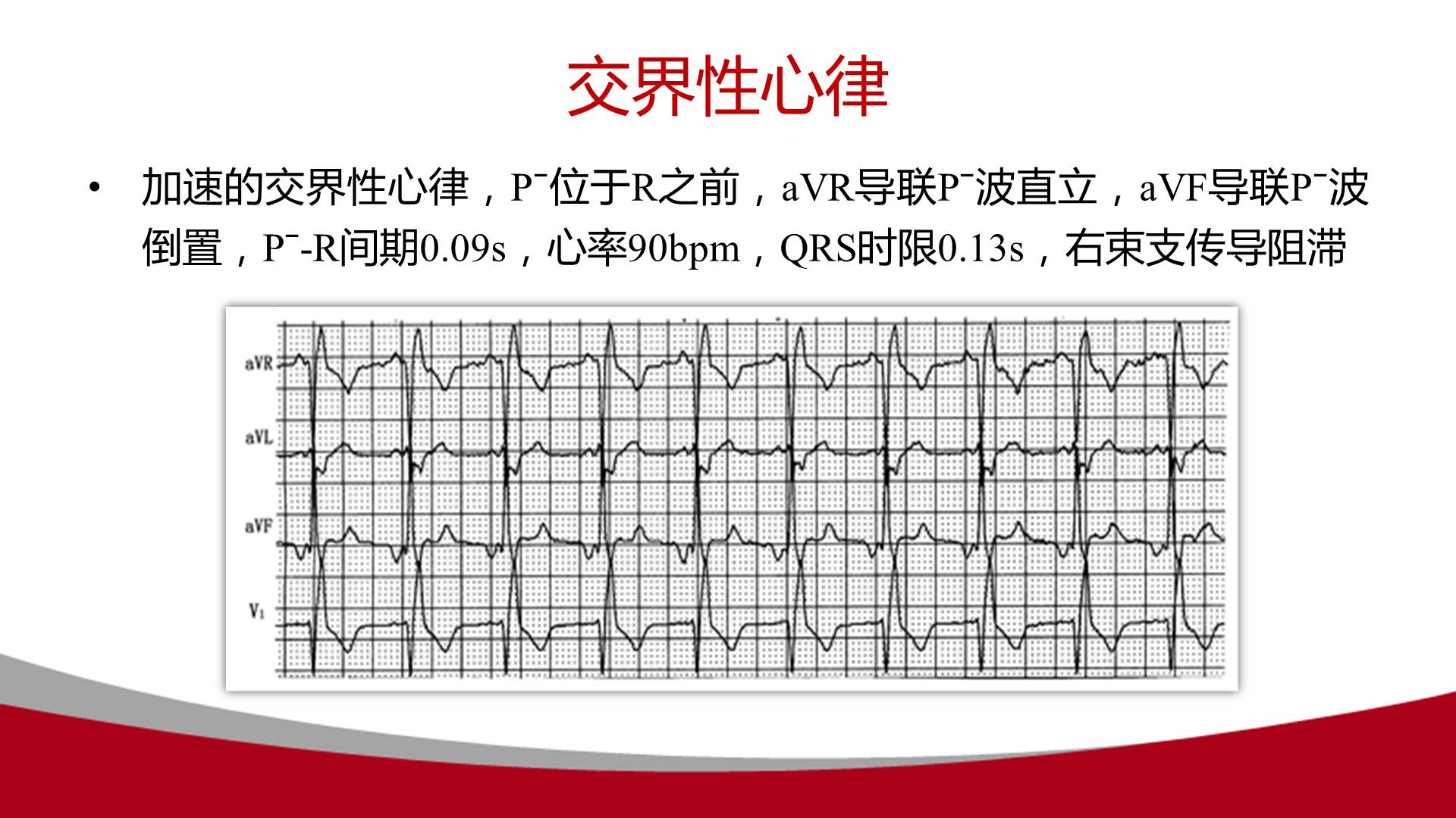 【连载】心电图的实用解析-1avr导联在动态心电图中的