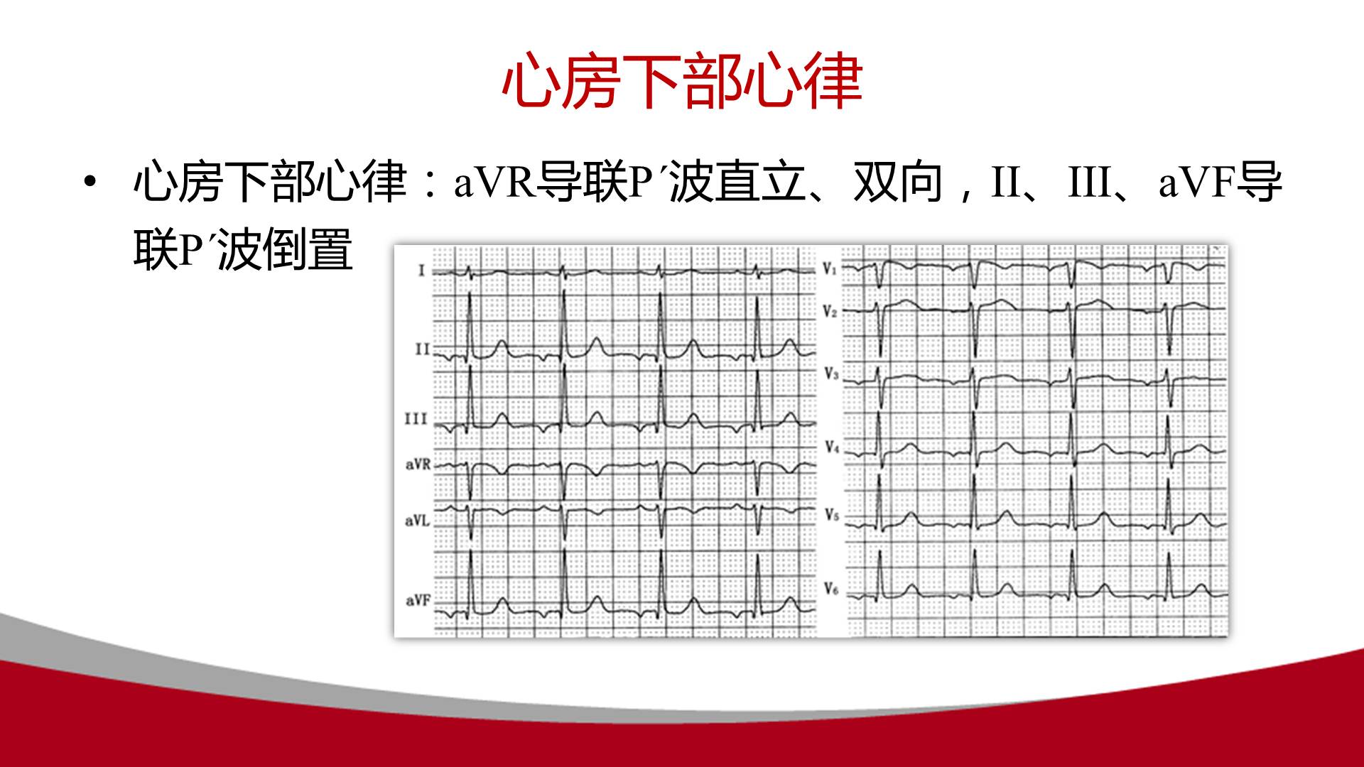 【连载】心电图的实用解析-1avr导联在动态心电图中的