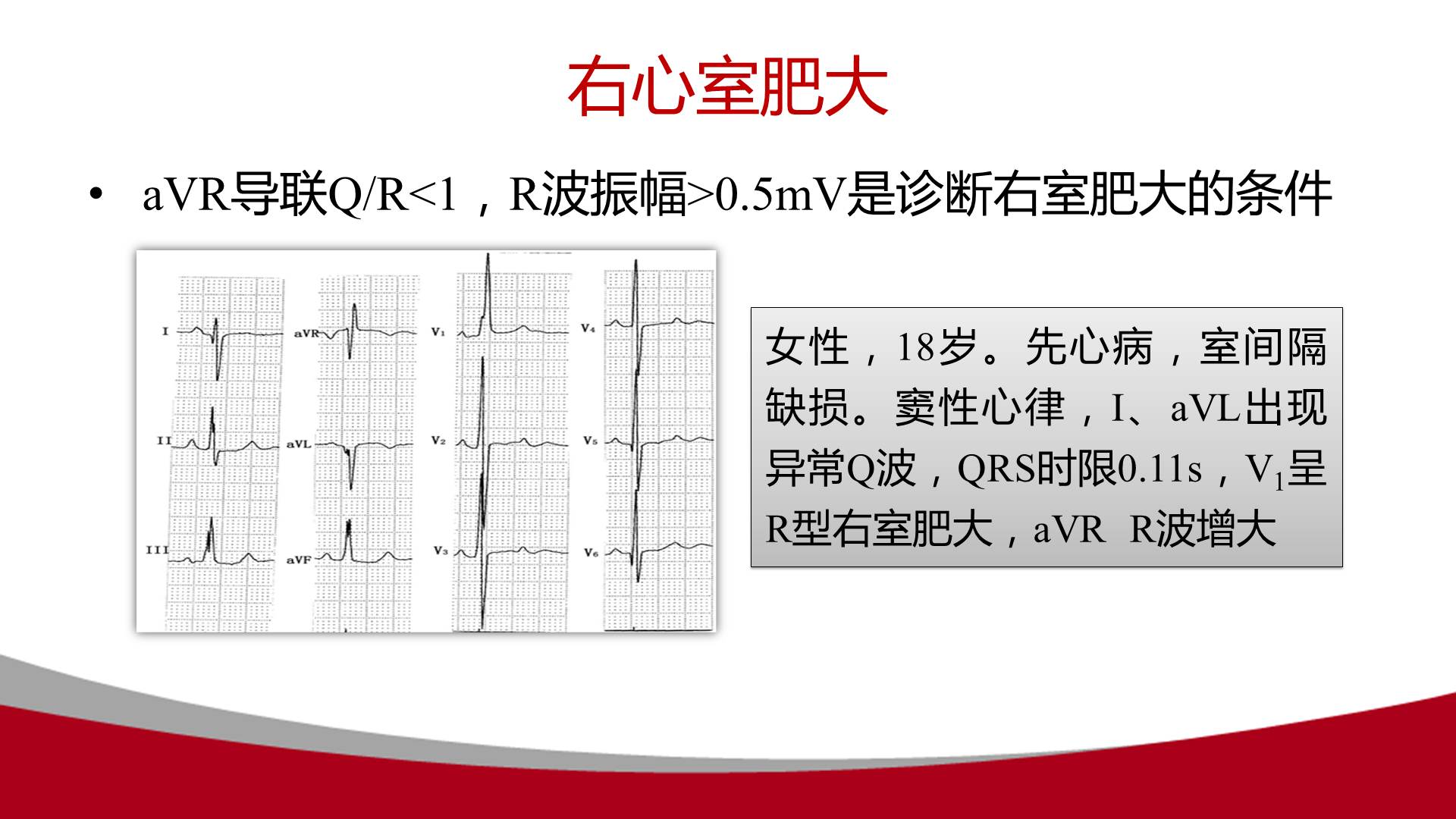 【连载】心电图的实用解析-1avr导联在动态心电图中的