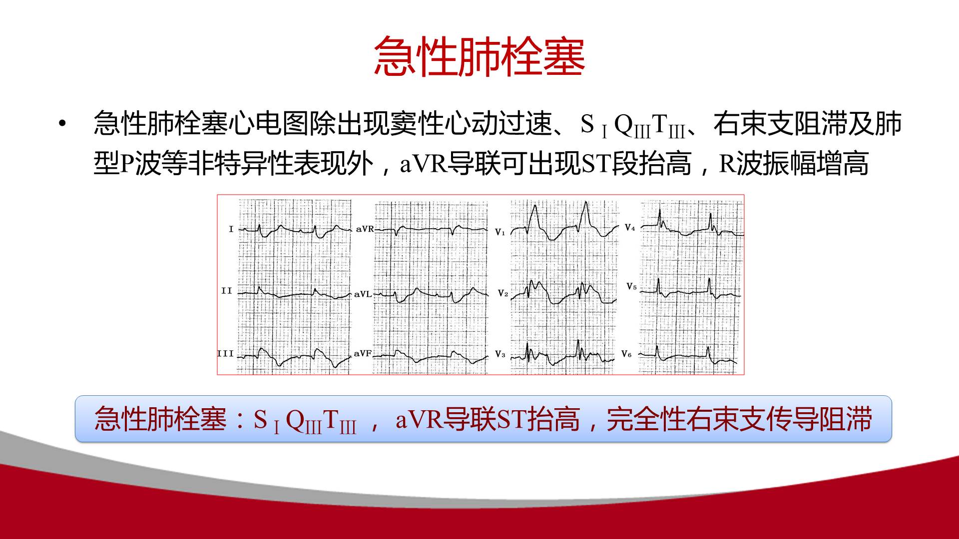 【连载】心电图的实用解析-1avr导联在动态心电图中的