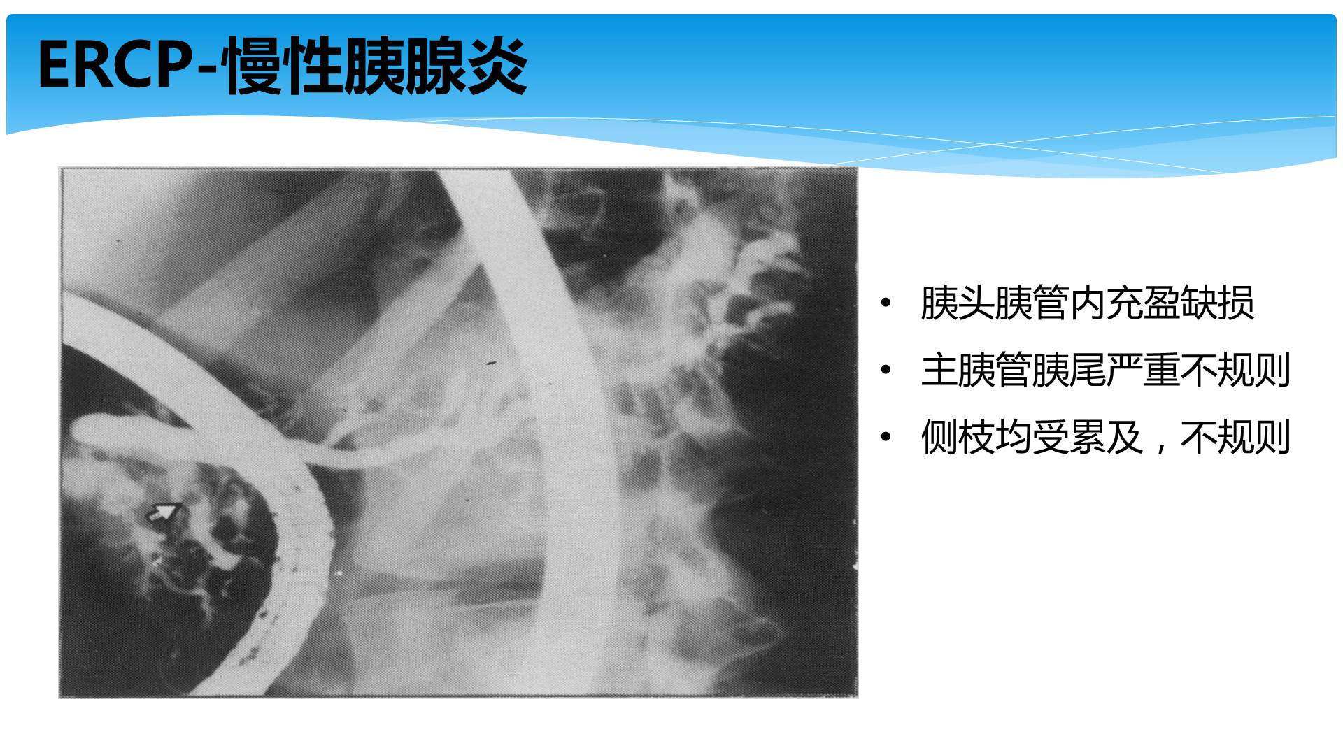 【连载】慢性胰腺炎的规范化诊断与治疗-3慢性胰腺炎的诊断方法(二)