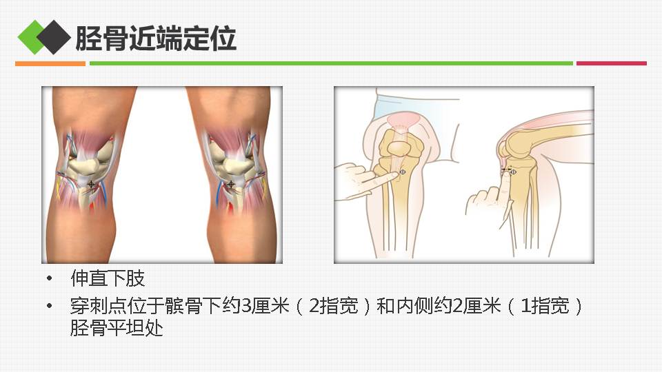 连载骨髓腔输液在危重症患者救治中应用3骨髓腔输液的具体操作