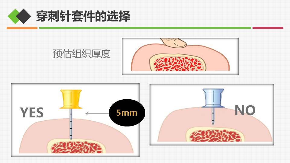 連載骨髓腔輸液在危重症患者救治中應用3骨髓腔輸液的具體操作