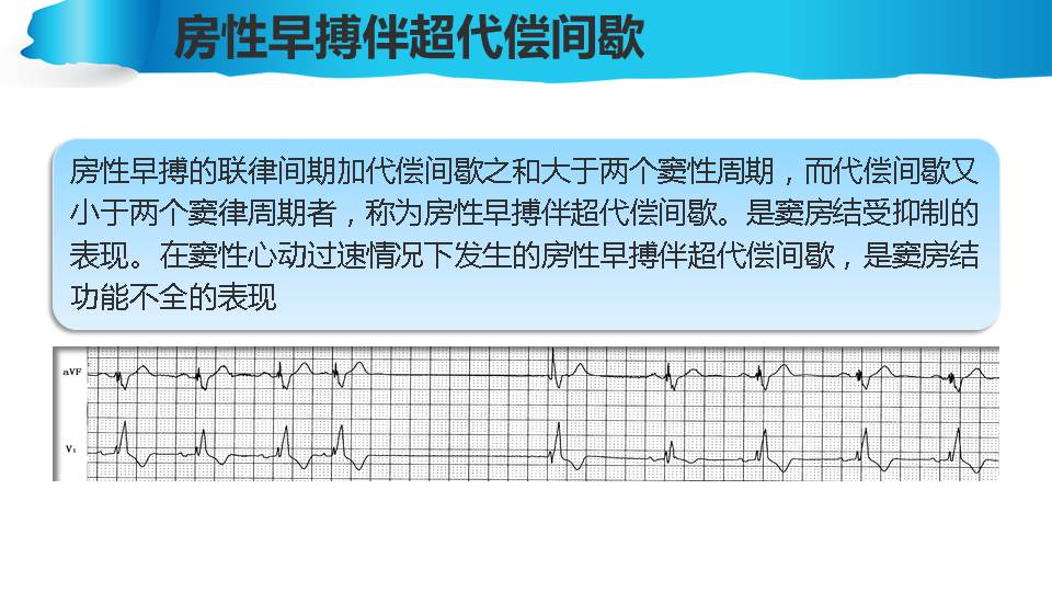 連載心電圖的實用解析4房性早搏伴心室內差異傳導的心電圖解析119頁