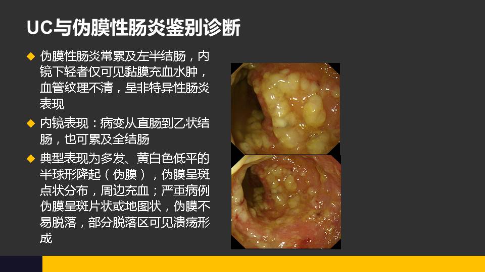 连载炎症性肠病的诊断探索1ibd内镜下鉴别诊断