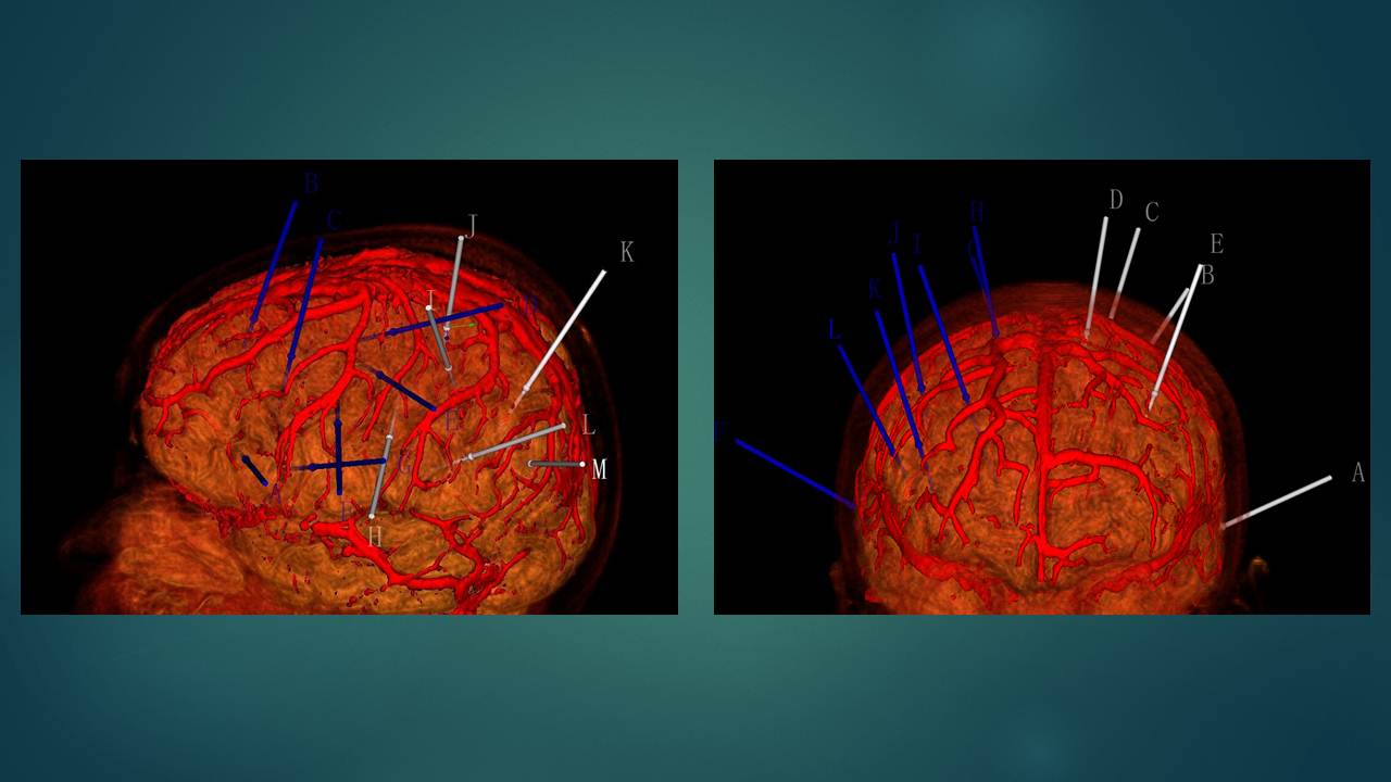 【连载】4-seeg在癫痫外科的应用-癫痫的脑电图诊疗技术