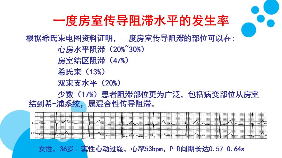 【连载】1房室(交界区)阻滞部位的心电图诊断-复杂的交界性早博的识别