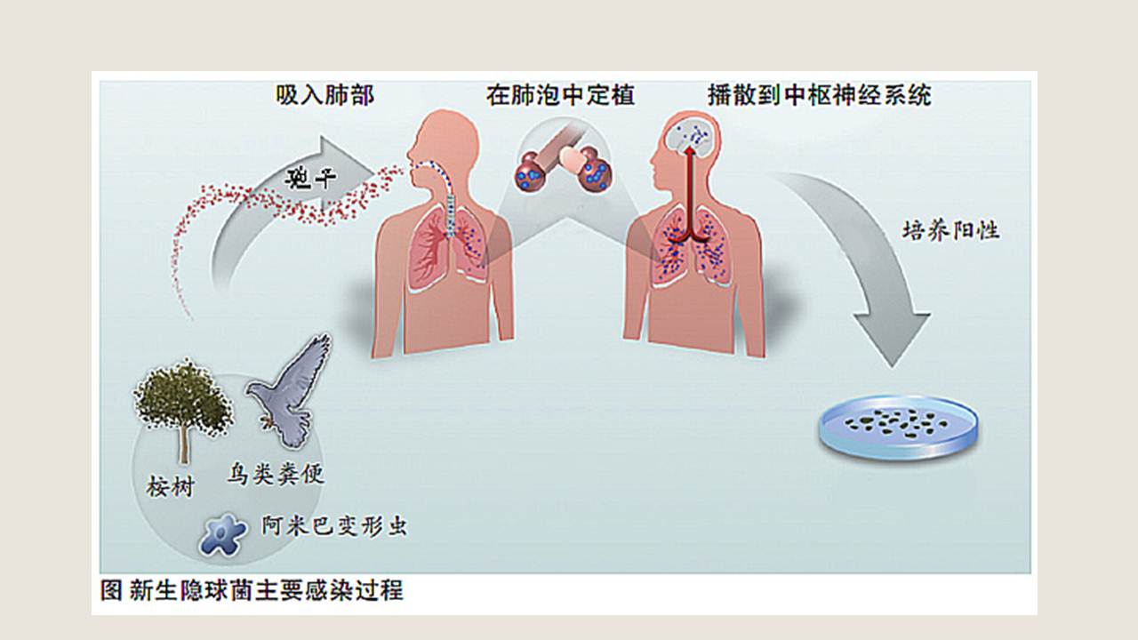 【连载】4新型隐球菌性脑膜炎的临床诊治-常见传染病的临床诊治策略