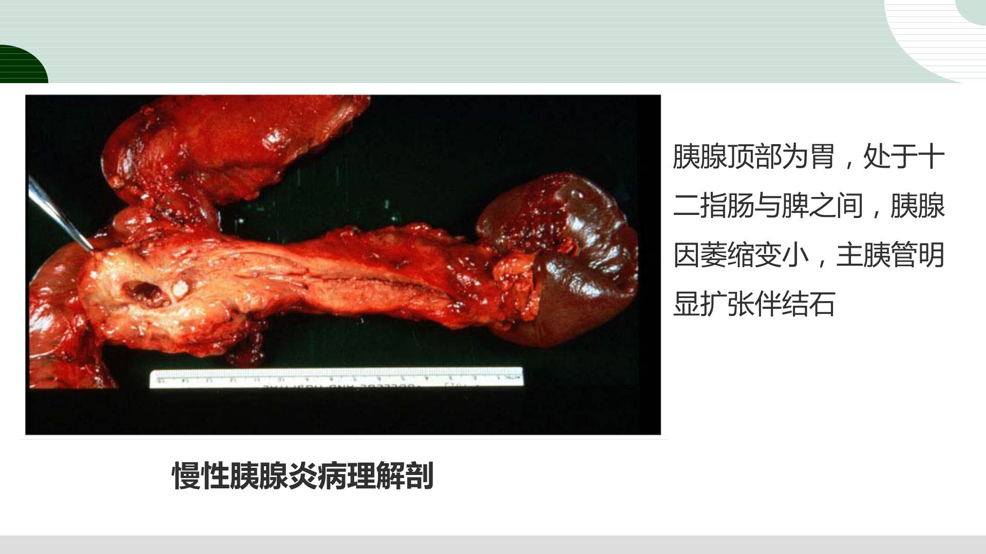 胰腺炎是什么病图片图片