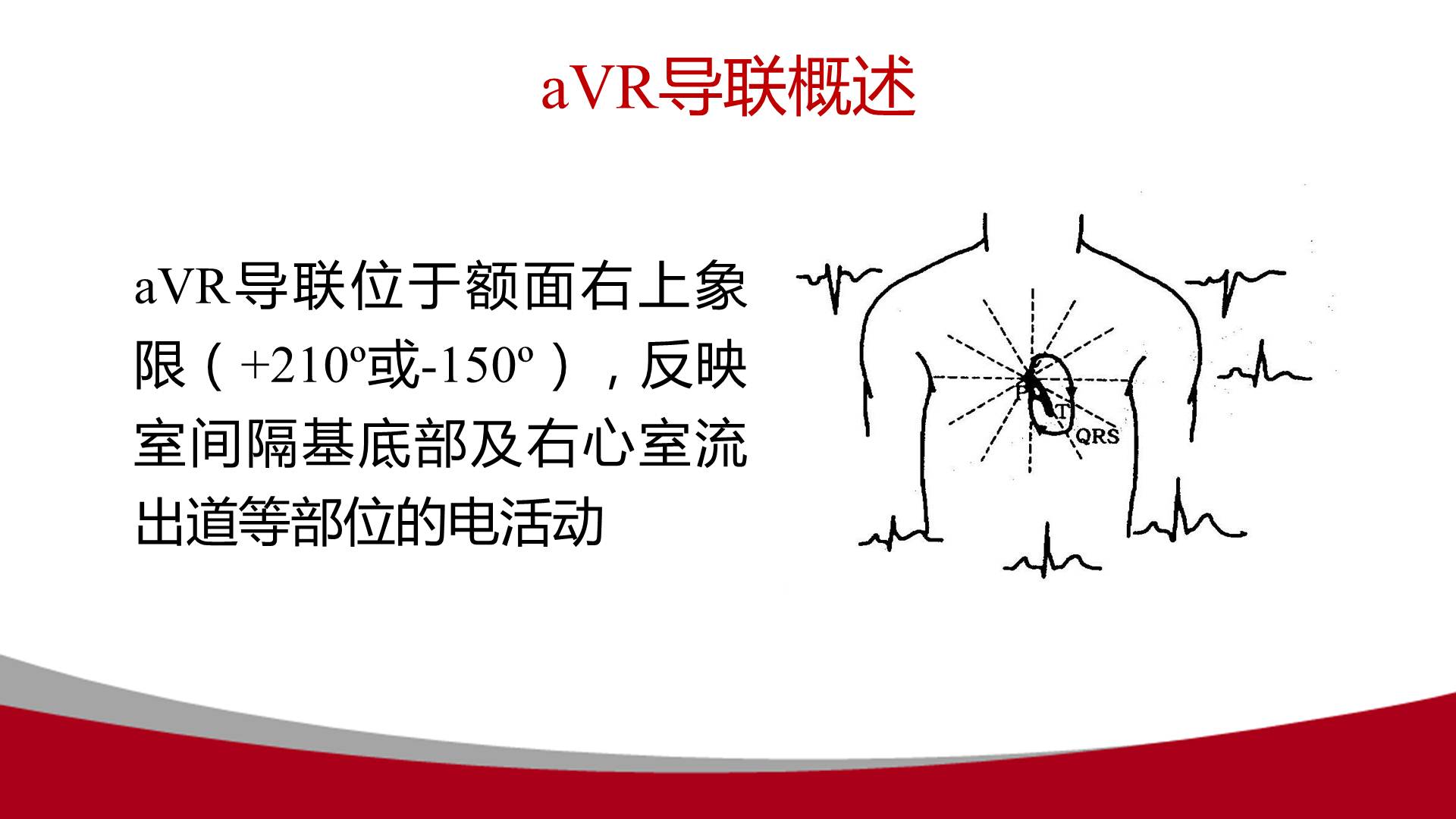 【连载】心电图的实用解析-1avr导联在动态心电图中的应用