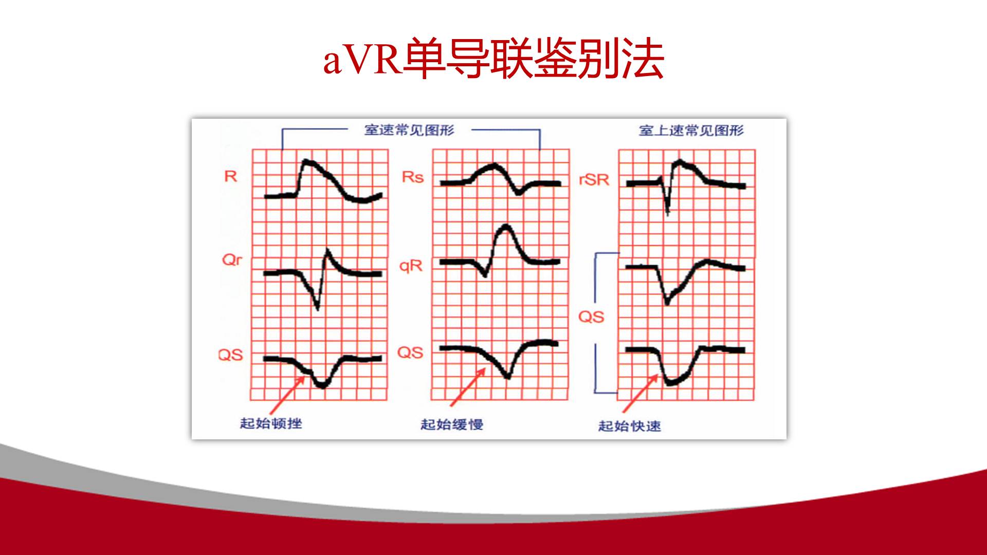 【连载】心电图的实用解析-1avr导联在动态心电图中的应用