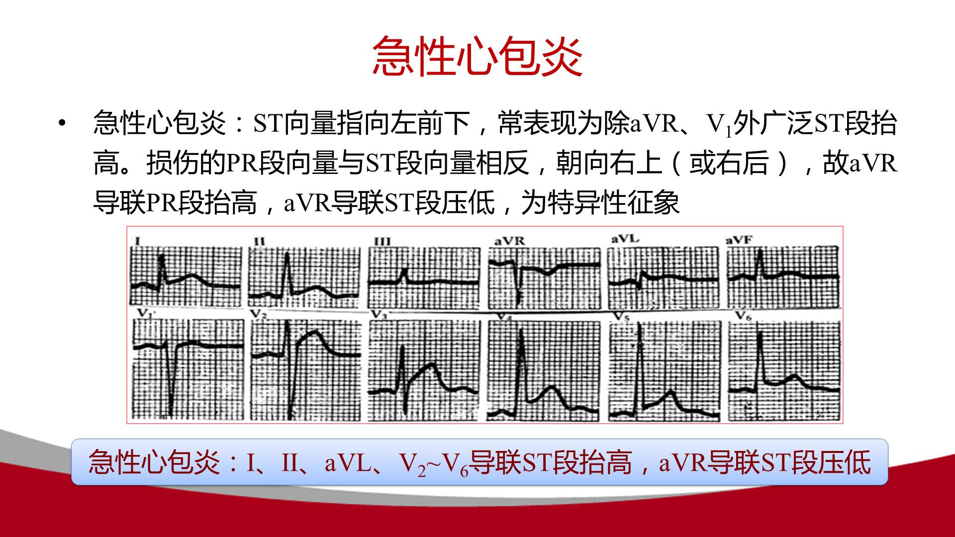 【連載】心電圖的實用解析-1avr導聯在動態心電圖中的應用